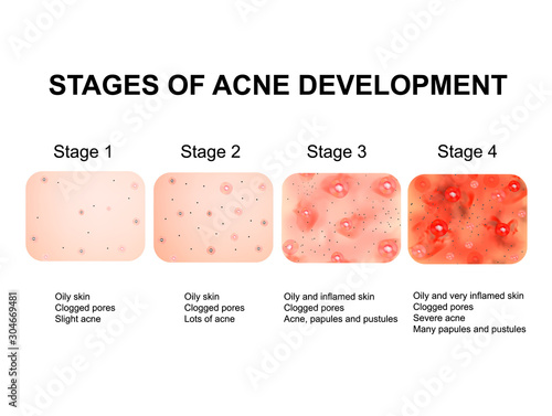Stages of development of acne. Inflamed skin with scars, acne and pimples. The texture of inflamed skin, and acne and pimples. Infographics. Vector illustration.