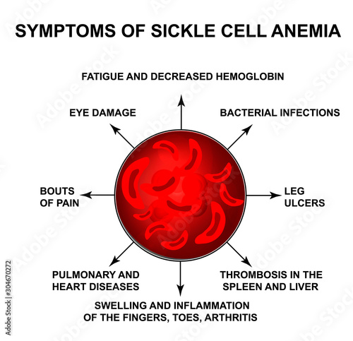 Symptoms of sickle cell anemia. World Sickle Cell Anemia Day 19 June. Red blood cells. Erythrocytes Sickle. Infographics. Vector illustration on isolated background.
