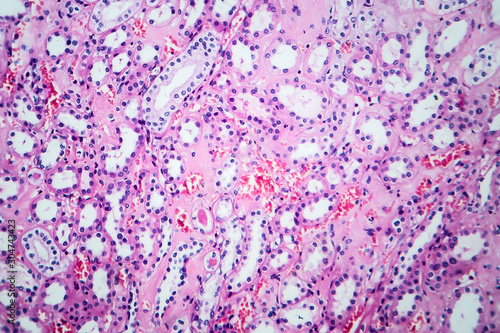 Histopathology of hypertensive renal disease, light micrograph, photo under microscope