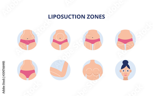 Liposuction zones set - female body parts with drawn lines for plastic surgery