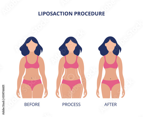 Liposuction procedure before and after banner flat vector illustration isolated.