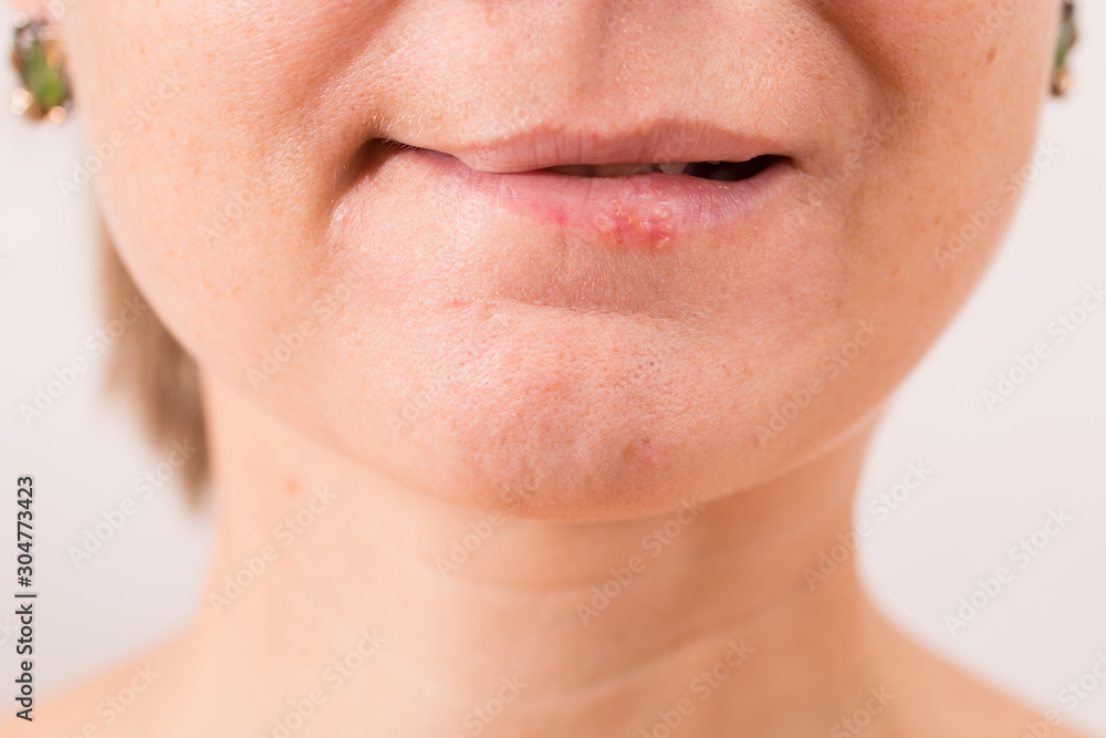Obraz premium Na rysunku w zbliżeniu przedstawiono kobiece usta cierpiące na opryszczkę