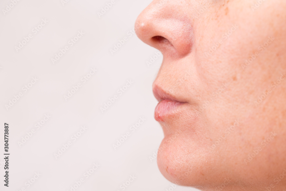 Close-up of female lips suffering from herpes Close-up of female lips suffering from herpes