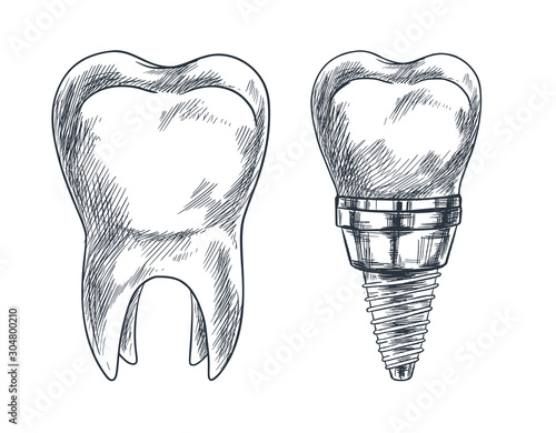 Molar tooth and implant, prothesis, sketch vector