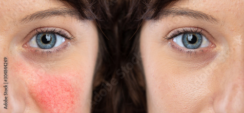 A young Caucasian girl shows the before and after results of intensive light surgery to remove the symptoms of rosacea showing reduction in cheek redness