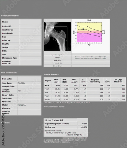 DEXA densitometry report of  hip scan. Osteopenia present, frequent precursor to osteoporosis.