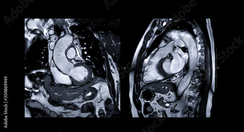 Fotografia MRI heart or Cardiac MRI ( magnetic resonance imaging ) of heart compare RVOT and LVOT for diagnosis heart disease