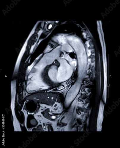 MRI heart or Cardiac MRI ( magnetic resonance imaging ) of heart  LVOT view for diagnosis heart disease.