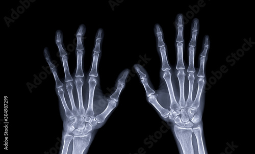 xray image of both hand AP view isolated on black  background  for diagnostic rheumatoid.