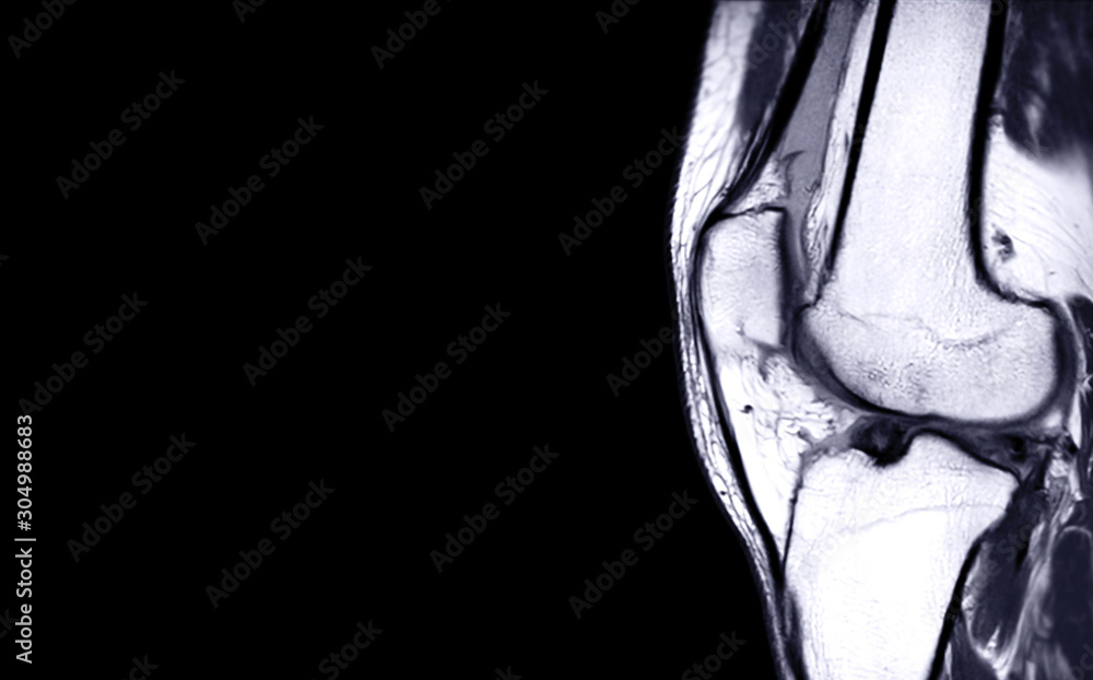 Compare of MRI Knee joint or Magnetic resonance imaging sagital view for detect tear or sprain of the anterior cruciate ligament (ACL) for background. Compare of MRI Knee joint or Magnetic resonance imaging sagital view for detect tear or sprain of the anterior cruciate ligament (ACL) for background.