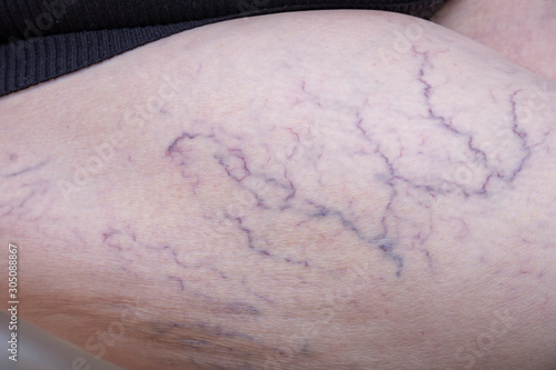 Εκτύπωση καμβά Enlarged varicose veins on a leg of a senior woman, phlebology concept