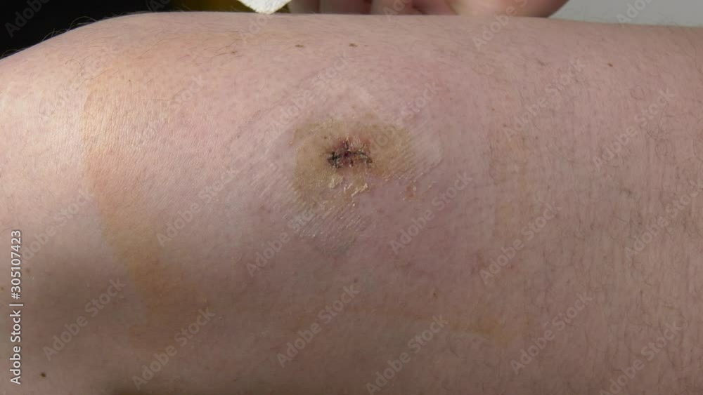 Close-up of a male hand removes a patch from a leg operation site. Field surgical aseptic patch is removed from the surgical site on the patients leg. Close-up of a male hand removes a patch from a leg operation site. Field surgical aseptic patch is removed from the surgical site on the patients leg.