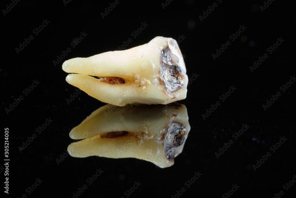 Kaputter Zahn mit Füllung und Karies auf schwarzem spiegelndem Untergrund