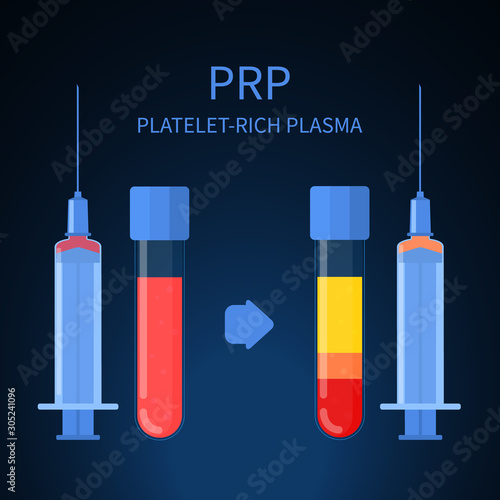 PRP procedure steps vector infographics. Test tubes and syringes filled with blood before and after separation of platelets in the centrifuge. Platelet-rich plasma regenerative medicine concept.
