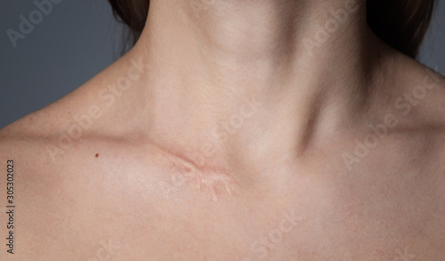 Woman with surgery scar at her neck. photo