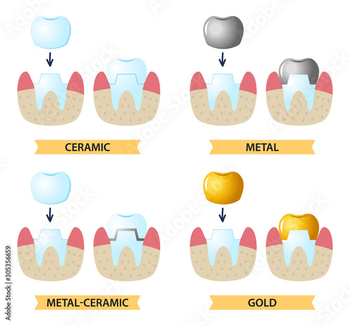 Icons on the dental Theme. Service installation of a ceramic crown. As well as a metal and gold crown on the tooth. Set icons flat style.