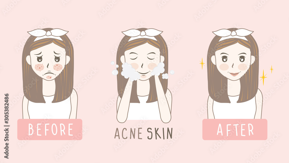 vector woman face. acne before and after. skin care illustration. vector woman face. acne before and after. skin care illustration.