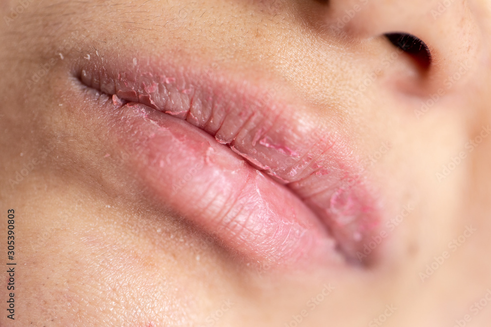 Fototapeta premium Backgrounds of Dry lips in the clinic.