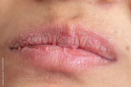 Backgrounds of Dry lips in the clinic.