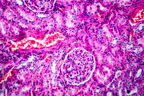 Histopathology of hypertensive renal disease, light micrograph, photo under microscope