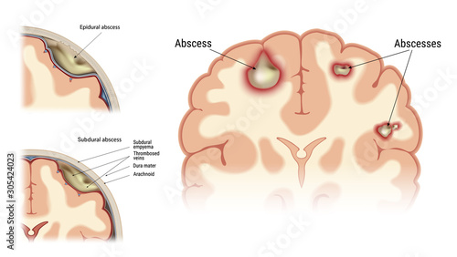 Abscess of the human brain. Visual image of the location of the focus of infectious inflammation.