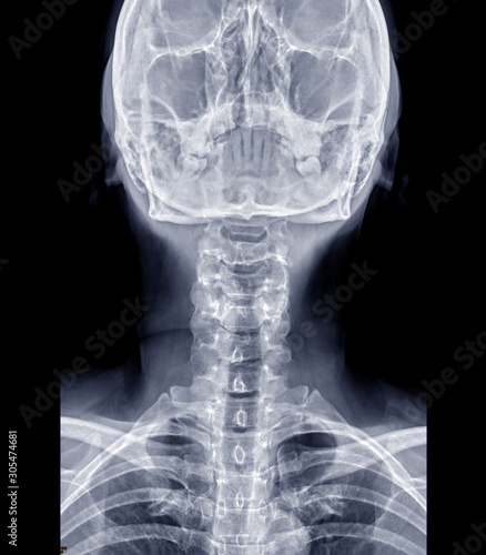 X-ray C-spine or x-ray image of Cervical spine AP view for diagnostic intervertebral disc herniation..