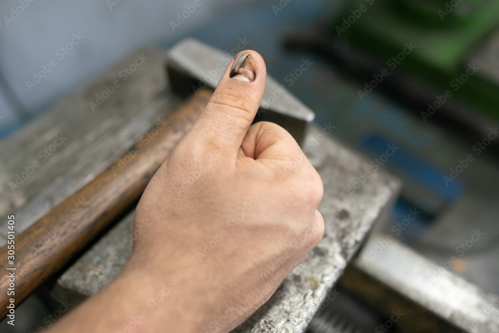Injured nail on the thumb of the right hand, close-up. Injured nail on the thumb of the right hand, close-up.