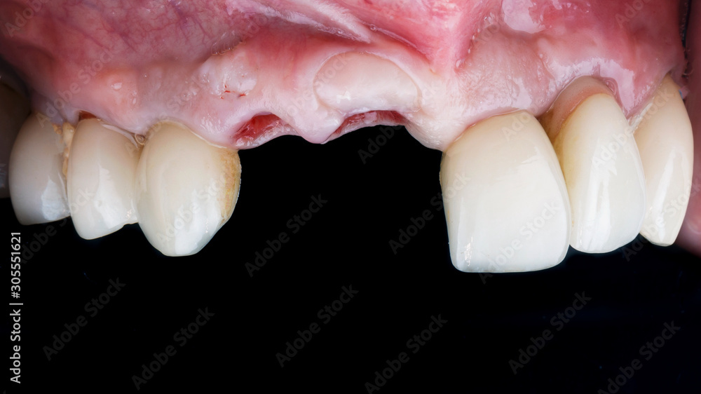 removed teeth in front of implantation and prosthetics
