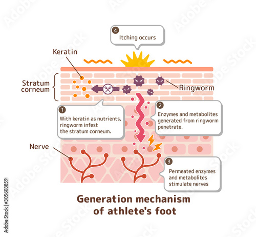 Generation mechanisim of athlete's foot ( ringworm) vector illustration / with English explanation texts.