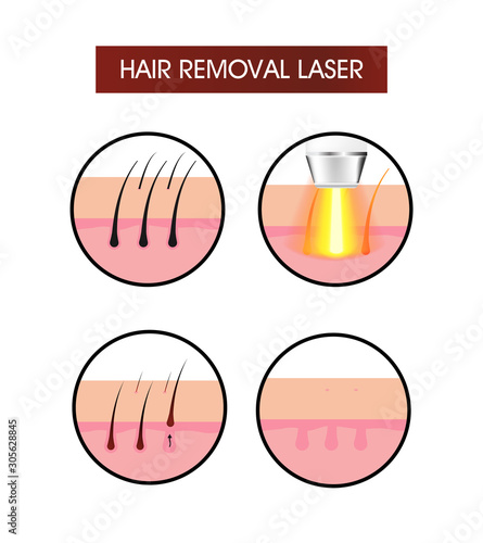 Hair removal laser icon. Vector sign