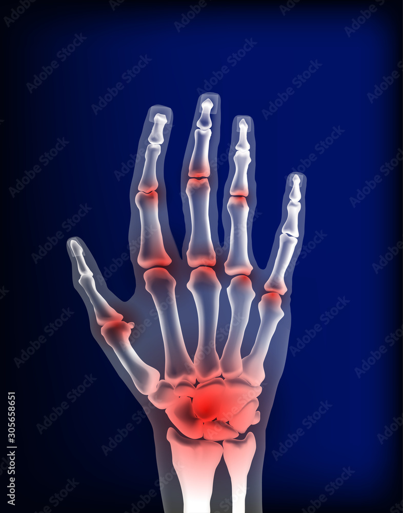 Obraz premium Osteoarthritis image sore inflammation joints of bones the of hand.