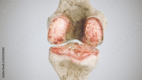 Tableau sur toile Advanced osteoarthritis - stage 3 - on the knee joint - high degree of detail -