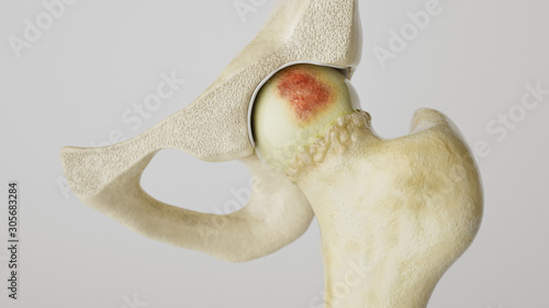 Stronger artheritis on the hip joint - high degree of detail - 3D Rendering