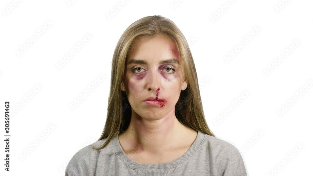 portrait of a girl on a white background, after domestic violence, with bruises on her face with bruises and bruises by sadines looking at the camera portrait of a girl on a white background, after domestic violence, with bruises on her face with bruises and bruises by sadines looking at the camera