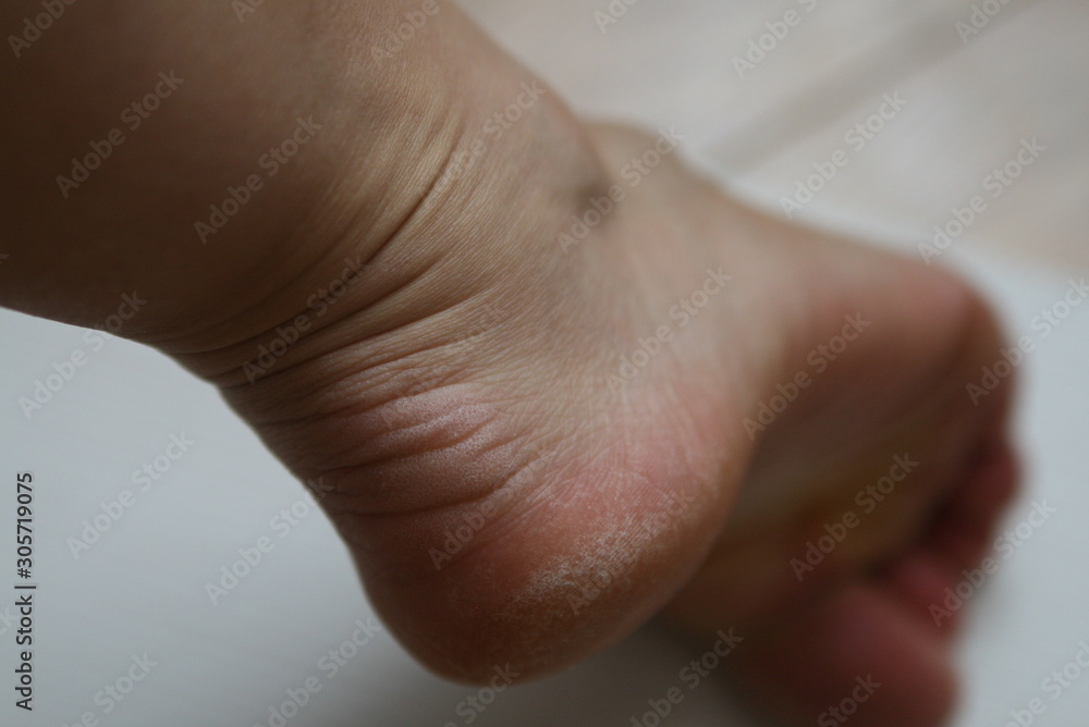 dry cracked skin on the heel, problems dry cracked skin on the heel, problems