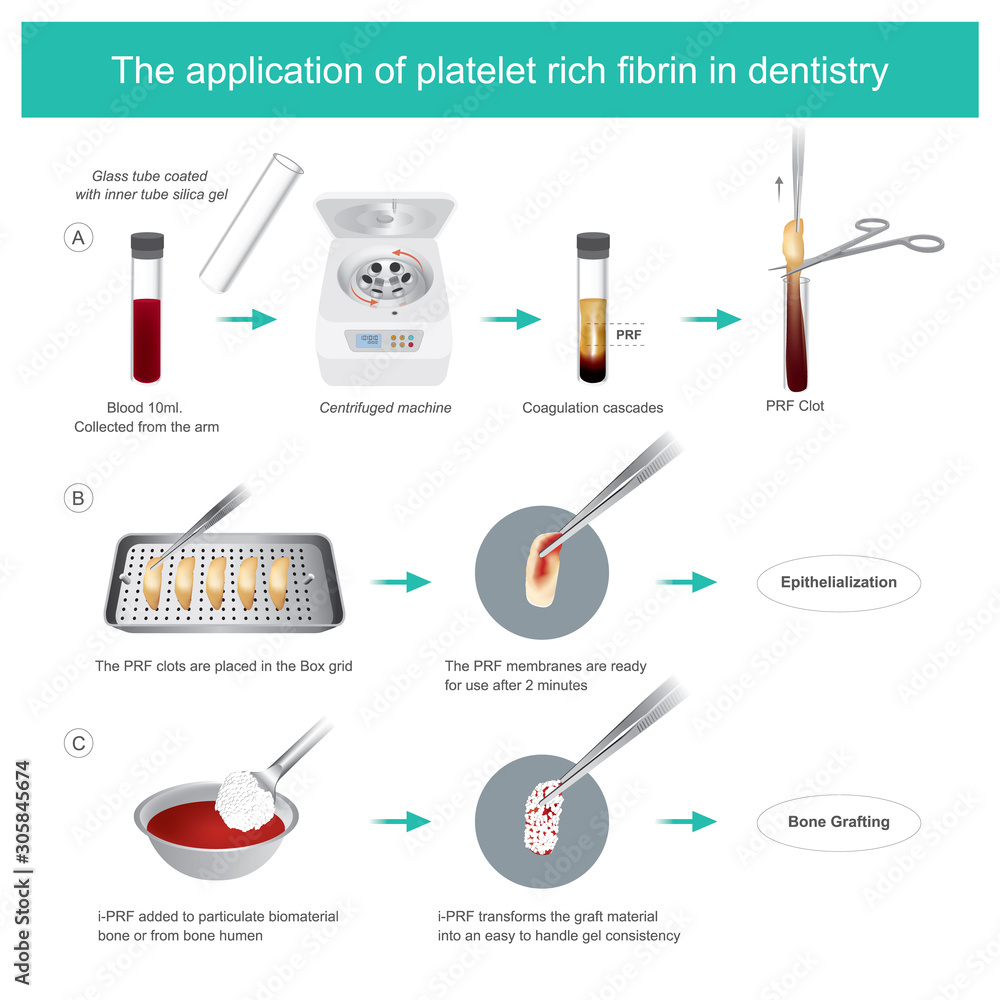 Fibrin-rich platelets (PRF) in dentistry. 