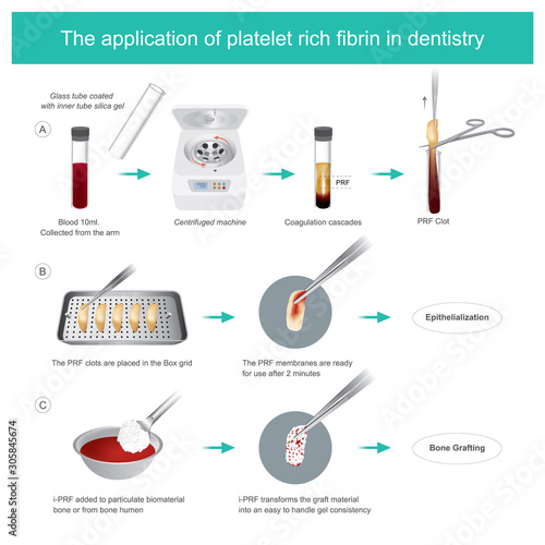 Fibrin-rich platelets (PRF) in dentistry. 