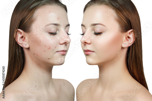 Face of beautiful woman before and after acne treatment.