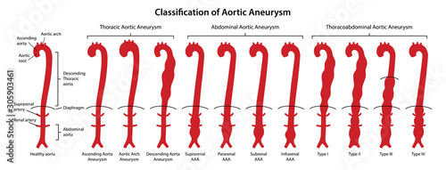Classification of Aortic Aneurysms. Healthy aorta with main parts labeled and aorta with various types of aneurysm. Vector illustration in flat style isolated on white background photo