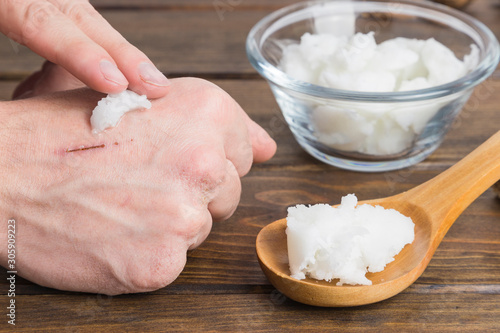 Hand applying natural coconut oil on a Skin wound. Wooden background.