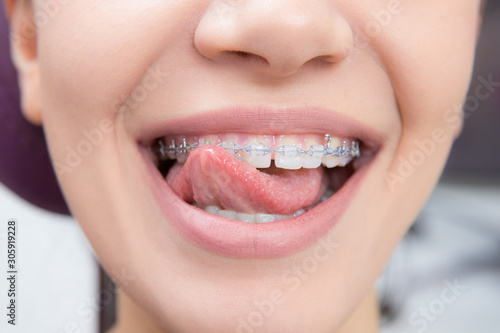 Smiling happy woman mouth with tongue and braces