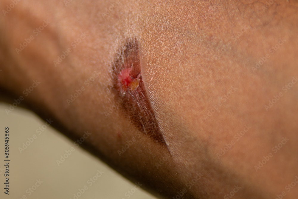 Fototapeta premium A burn mark in a black skin arm