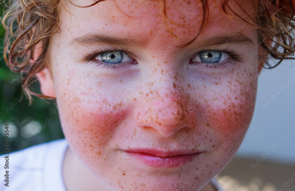 red painful skin, sunburn on the boy's face, sunburn protection need,  close-up face of a cute caucasian boy with a sunscreen on his nose, which  burned in the sun, freckles face Stock