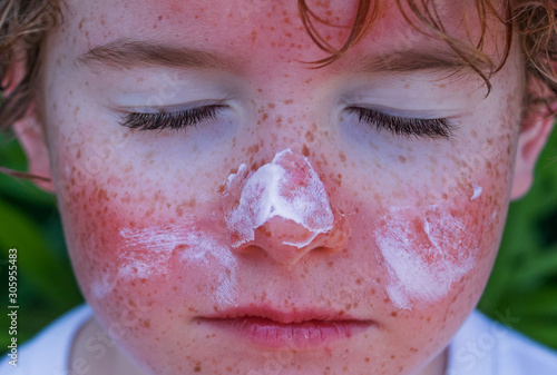 red painful skin, sunburn on the boy's face, sunburn protection need, close-up face of a cute caucasian boy with a sunscreen on his nose, which burned in the sun, freckles face