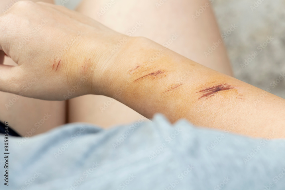 The wound form scabs on hand and arm. The wound happen during woman Injuries from falling down on road. The wound form scabs on hand and arm. The wound happen during woman Injuries from falling down on road.