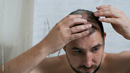 Fight against hair loss in men. Shots to the head. Treatment of male pattern baldness. Early hair loss. A man uses a cream hair growth