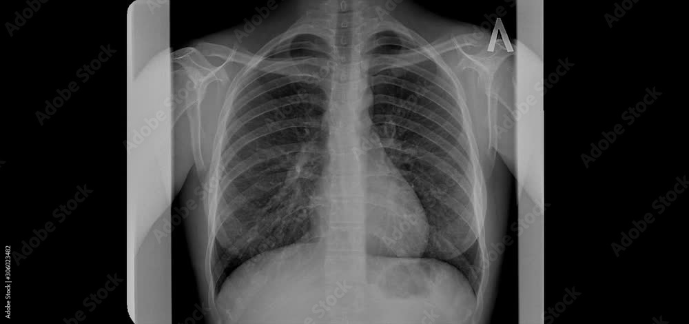 Fluorogram. X ray picture of human lungs