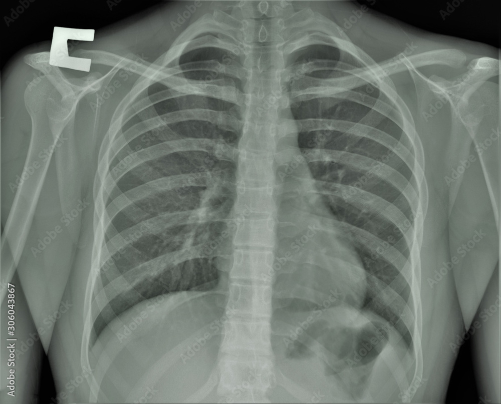 normal radiography of the shoulder joint and ribs in direct projection, Traumatology and orthopedics,pulmonology normal radiography of the shoulder joint and ribs in direct projection, Traumatology and orthopedics,pulmonology