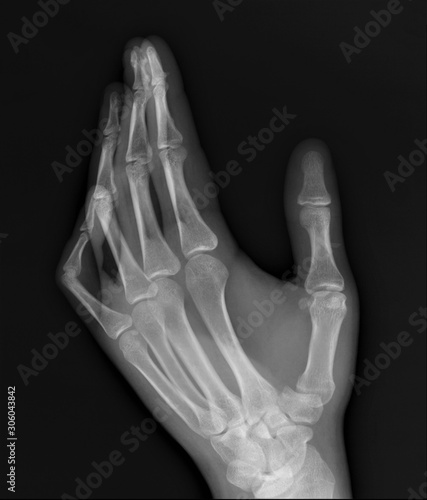 normal x-ray of the hand bones and fingers,orthopedics, medical diagnostics, rheumatology