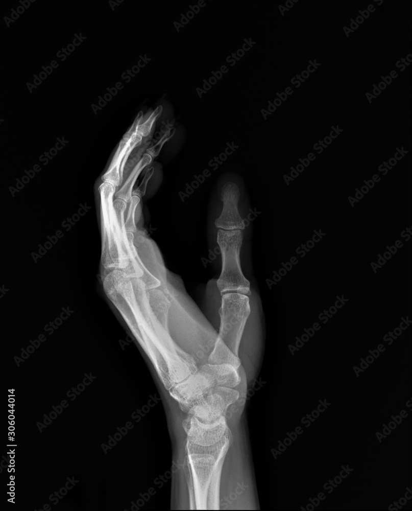normal x-ray of the hand bones and fingers,orthopedics, medical diagnostics, rheumatology normal x-ray of the hand bones and fingers,orthopedics, medical diagnostics, rheumatology